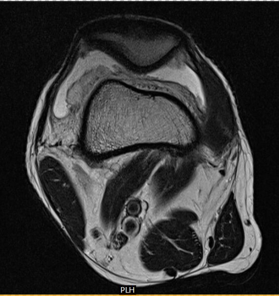File:Accessory lateral gastrocnemius muscle (Radiopaedia 13442-13397 Axial T2 1).jpg
