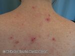 Acne urticata (DermNet NZ acne-w-acne-urticata-2).jpg