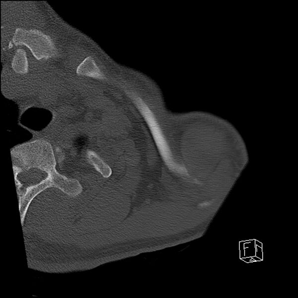 File:Acromioclavicular joint dissociation - type IV (Radiopaedia 64411-73216 Axial bone window 4).jpg