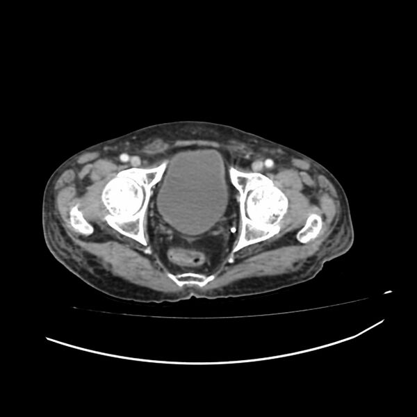 File:Acute-on-chronic Crohn disease with enteroenteric fistula (Radiopaedia 66686-75987 B 81).jpg