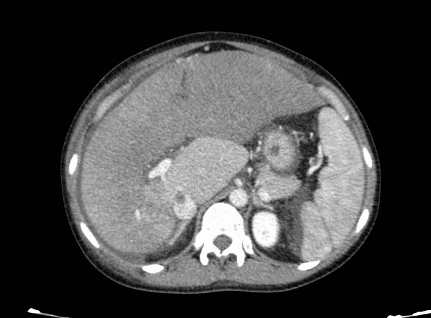 Acute Budd-Chiari syndrome (Radiopaedia 60858-68638 Axial C+ portal venous phase 93).jpg