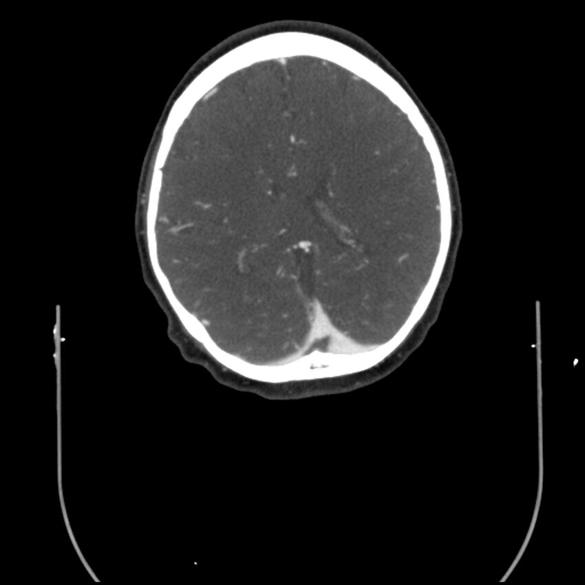 Acute M1 occlusion with ischemic penumbra (CT perfusion) (Radiopaedia 71897-82344 Axial C+ arterial phase thins 30).jpg