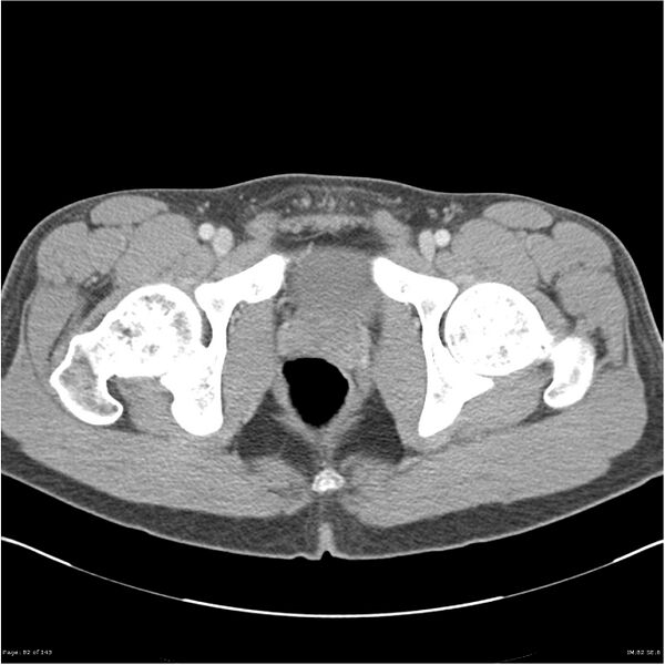 File:Acute appendicitis (Radiopaedia 25364-25615 B 72).jpg
