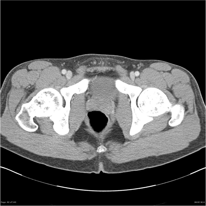 Acute appendicitis (Radiopaedia 25364-25615 B 72).jpg