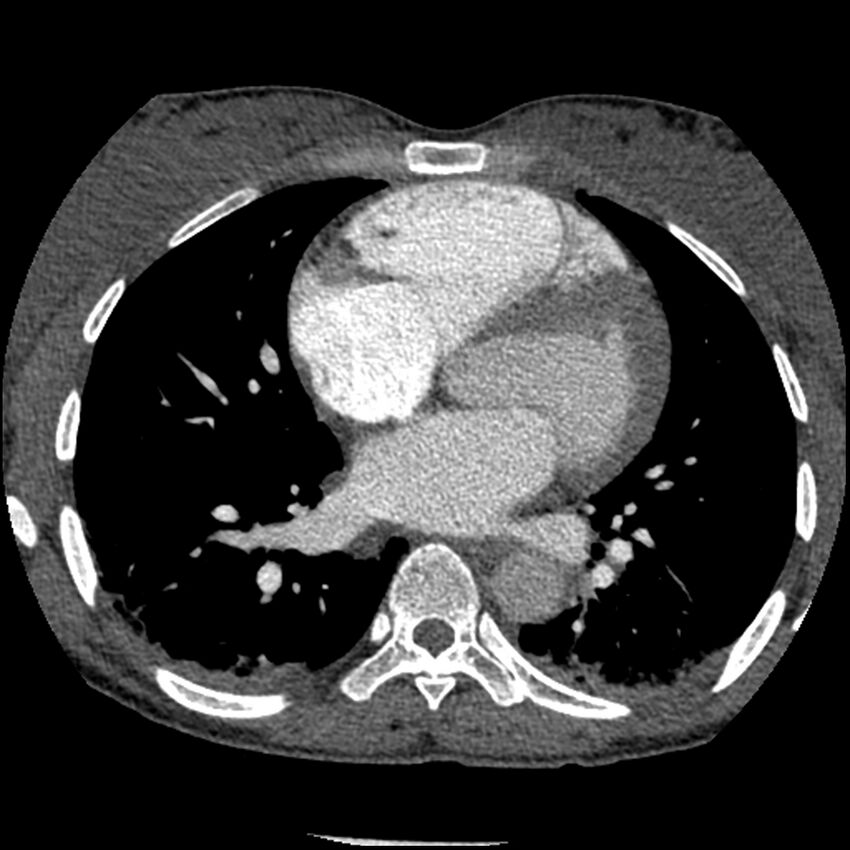 Acute chest syndrome - sickle cell disease (Radiopaedia 42375-45499 Axial C+ CTPA 109).jpg