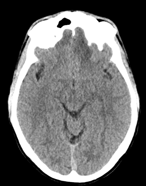 File:Acute disseminated encephalomyelitis (ADEM) (Radiopaedia 65319-74348 Axial non-contrast 14).png