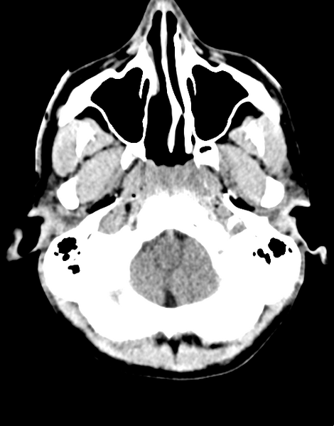File:Acute disseminated encephalomyelitis (ADEM) (Radiopaedia 65319-74348 Axial non-contrast 5).png