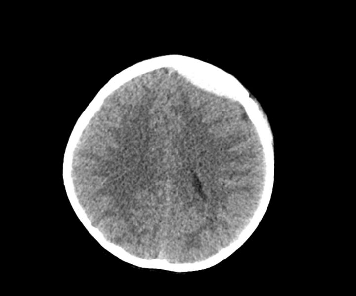 File:Acute epidural hematoma (Radiopaedia 63659-72335 Axial non-contrast 16).jpg