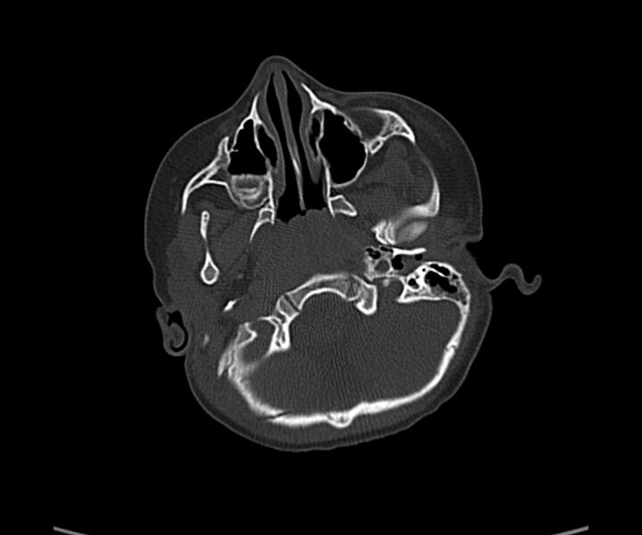 File:Acute hemorrhagic contusion (Radiopaedia 63660-72336 Axial bone window 12).jpg
