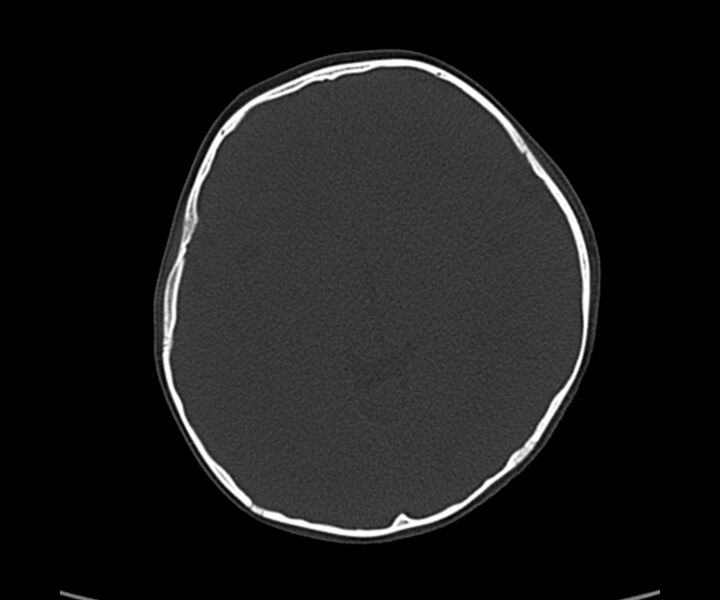 File:Acute hemorrhagic contusion (Radiopaedia 63660-72336 Axial bone window 32).jpg