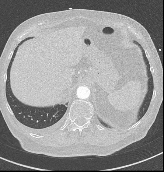 File:Acute myocardial infarction (Radiopaedia 23413-23481 lung window 67).jpg
