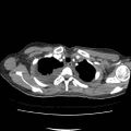 Acute myocarditis (Radiopaedia 55988-62613 C 18).jpg