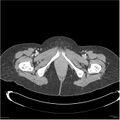 Acute pancreatitis (Radiopaedia 19136-19117 Axial C+ portal venous phase 46).jpg