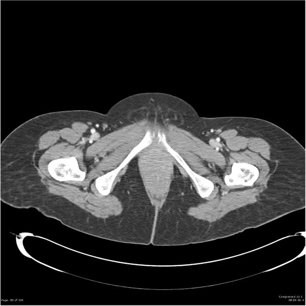 File:Acute pancreatitis (Radiopaedia 19136-19117 Axial C+ portal venous phase 46).jpg