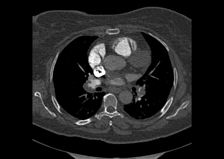 Acute pulmonary embolism (Radiopaedia 29938-30466 Axial C+ CTPA 83).jpg
