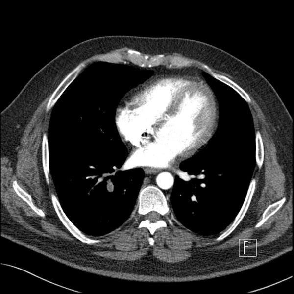 File:Acute pulmonary embolism with pulmonary infarct (Radiopaedia 73062-83768 Axial C+ CTPA 47).jpg