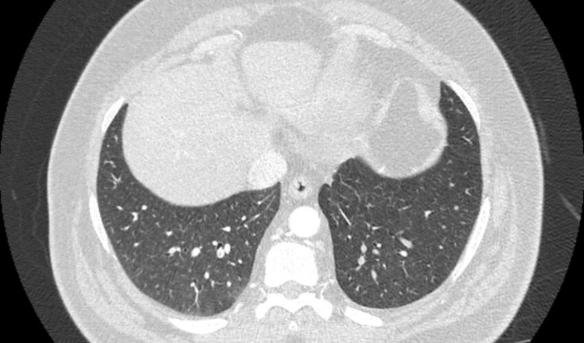 Acute pulmonary embolism with pulmonary infarcts (Radiopaedia 77688-89908 Axial lung window 101).jpg