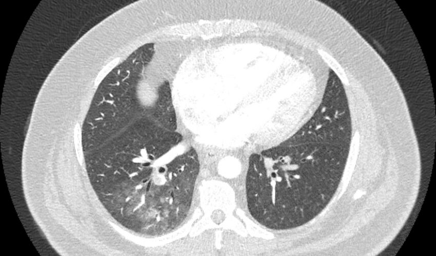 Acute pulmonary embolism with pulmonary infarcts (Radiopaedia 77688-89908 Axial lung window 81).jpg