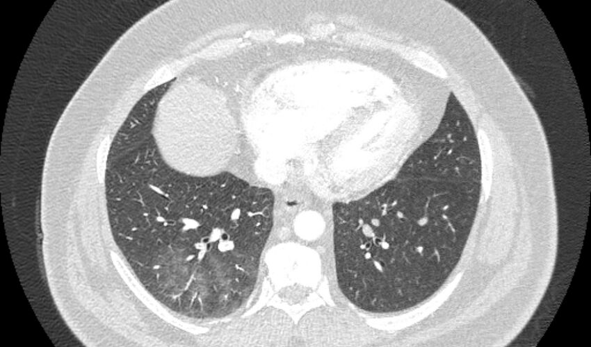 Acute pulmonary embolism with pulmonary infarcts (Radiopaedia 77688-89908 Axial lung window 89).jpg