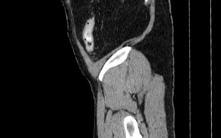 Acute sigmoid colon diverticulitis (Radiopaedia 55507-61976 Sagittal C+ portal venous phase 135).jpg