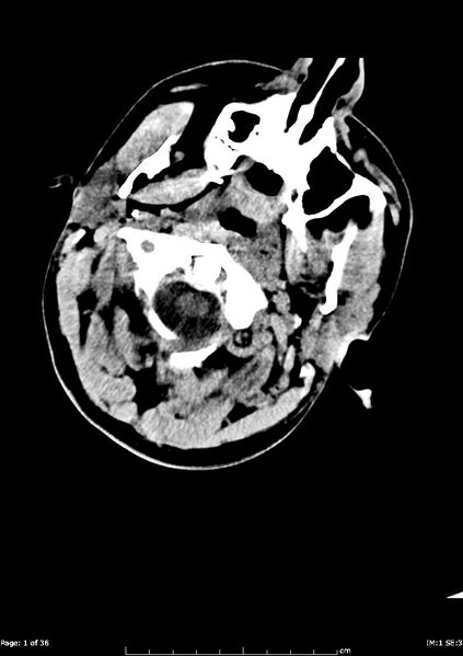 File:Acute subdural hematoma (Radiopaedia 23111).jpg