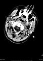 Acute subdural hematoma (Radiopaedia 23111).jpg