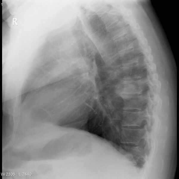 File:Adenocarcinoma of lung (Radiopaedia 24509-24798 Lateral 1).jpg
