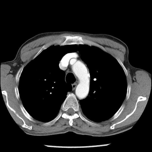 File:Adenocarcinoma of the lung - micropapillary predominant (Radiopaedia 42446-45563 Axial C+ portal venous phase 20).jpg