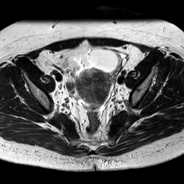 File:Adenomyoma of the uterus (Radiopaedia 9871-10439 Axial T2 19).jpg