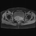 Adenomyosis and endometriotic cysts (Radiopaedia 82300-96367 Axial T1 C+ fat sat 7).jpg
