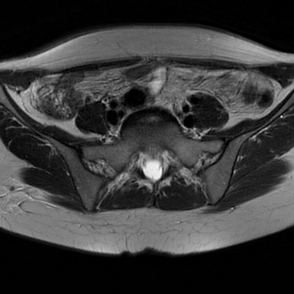 File:Adenomyosis within a septate uterus (Radiopaedia 69963-79981 Axial T2 10).jpg
