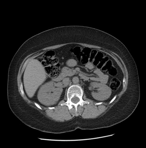 File:Adrenal cortical carcinoma with IVC invasion and thrombosis (Radiopaedia 34307-35597 Axial non-contrast 23).jpg