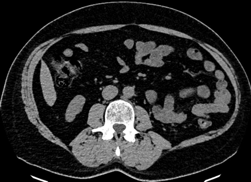 File:Adrenal metastases (Radiopaedia 73082-83791 Axial non-contrast 98).jpg