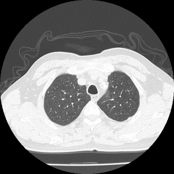 File:Airway foreign body in adult (Radiopaedia 85907-101779 Axial lung window 20).jpg