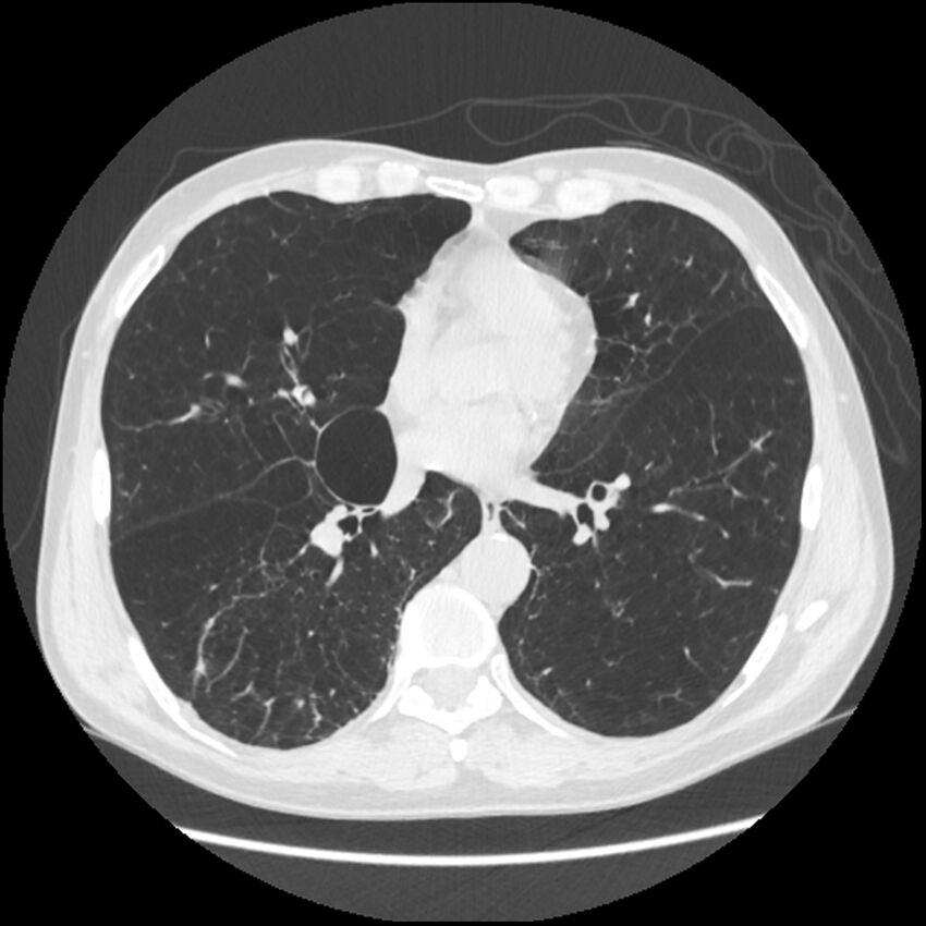 Alpha-1-antitrypsin deficiency (Radiopaedia 40993-43722 Axial lung window 144).jpg