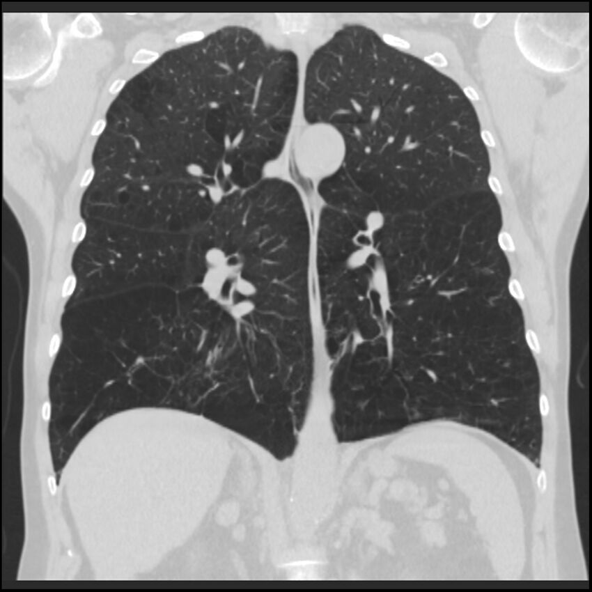 Alpha-1-antitrypsin deficiency (Radiopaedia 40993-43722 Coronal lung window 60).jpg