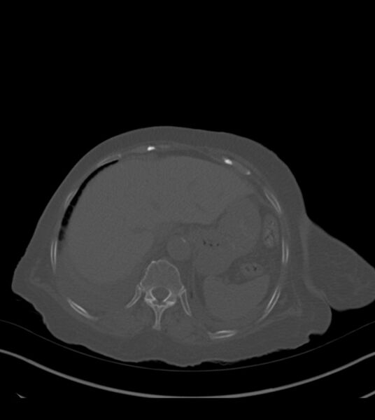 File:Amiodarone deposition in the liver (Radiopaedia 77587-89780 Axial bone window 73).jpg