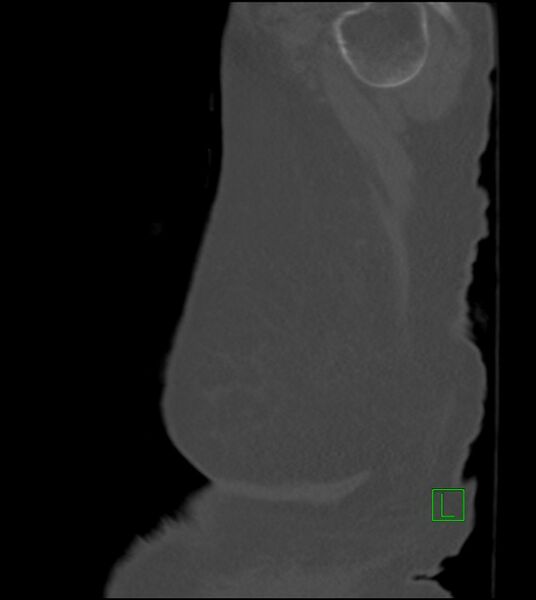 File:Amiodarone deposition in the liver (Radiopaedia 77587-89780 Sagittal bone window 6).jpg
