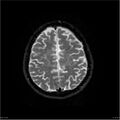 Amnestic syndrome secondary to hypoxic brain injury (Radiopaedia 24743-25004 DWI 56).jpg