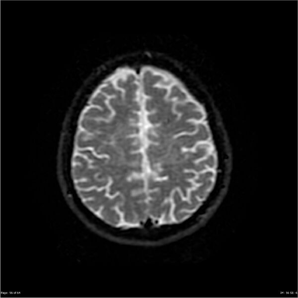 File:Amnestic syndrome secondary to hypoxic brain injury (Radiopaedia 24743-25004 DWI 56).jpg