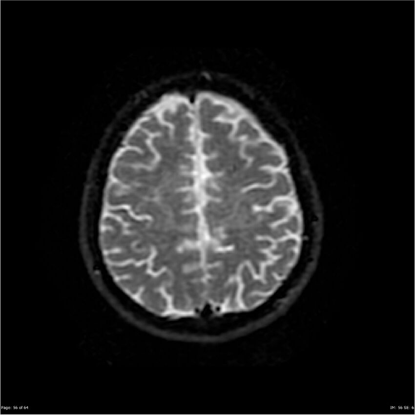 Amnestic syndrome secondary to hypoxic brain injury (Radiopaedia 24743-25004 DWI 56).jpg