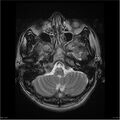 Amnestic syndrome secondary to hypoxic brain injury (Radiopaedia 24743-25004 T2 4).jpg