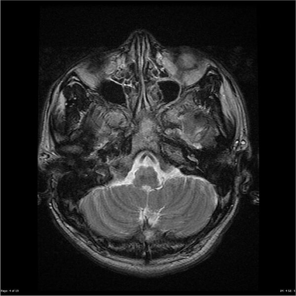 File:Amnestic syndrome secondary to hypoxic brain injury (Radiopaedia 24743-25004 T2 4).jpg