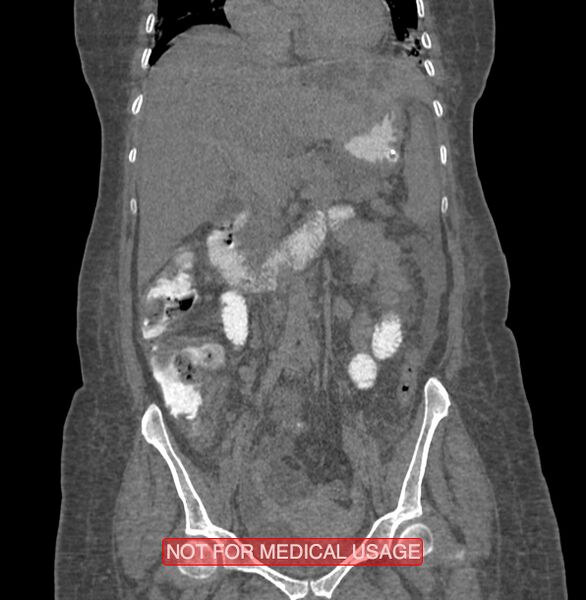 File:Amoebic enterocolitis with liver abscess (Radiopaedia 35100-36609 B 89).jpg