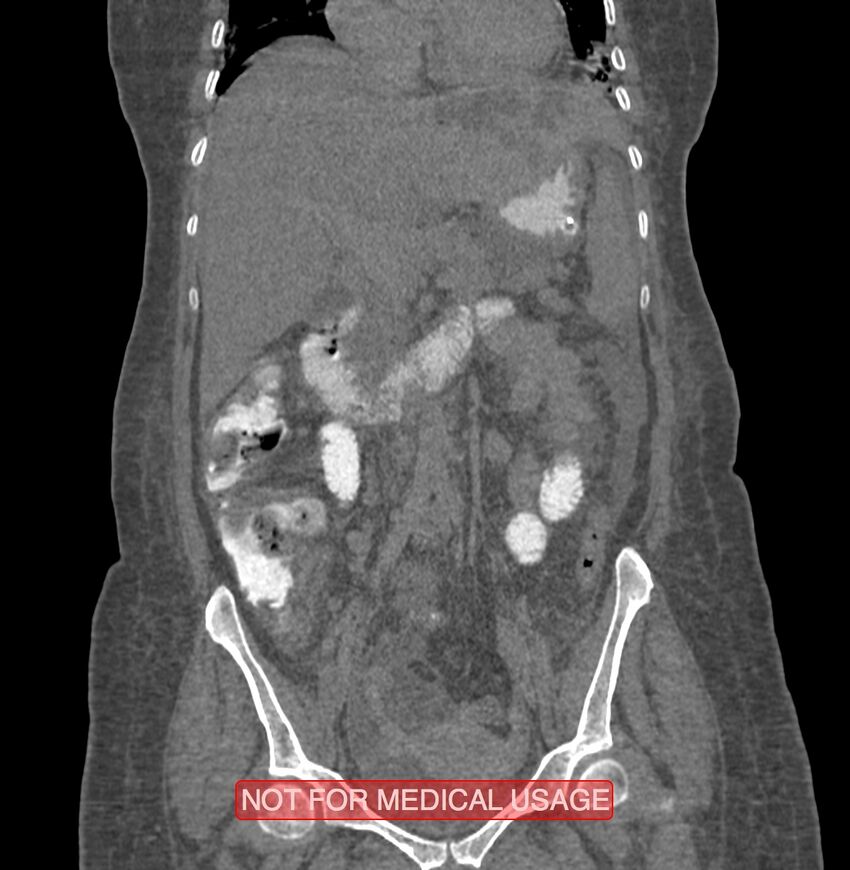 Amoebic enterocolitis with liver abscess (Radiopaedia 35100-36609 B 89).jpg
