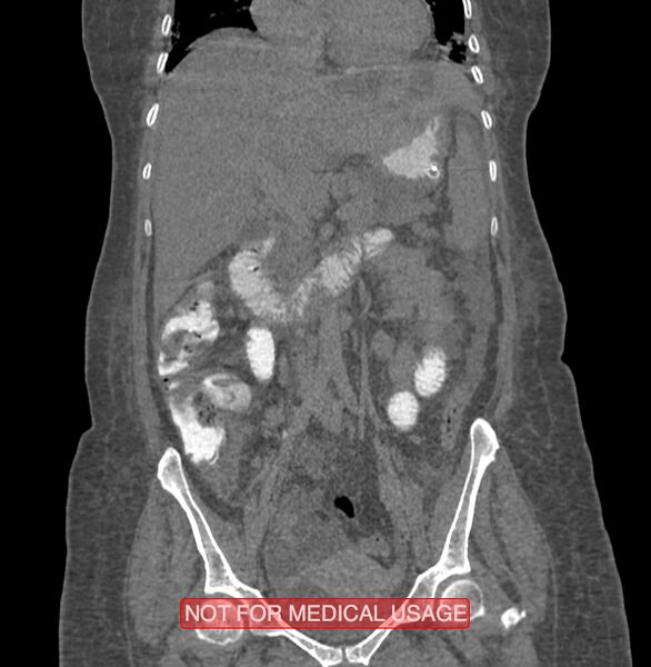 File:Amoebic enterocolitis with liver abscess (Radiopaedia 35100-36609 B 91).jpg