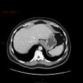 Ampullary carcinoma (Radiopaedia 56396-63056 C 16).jpg