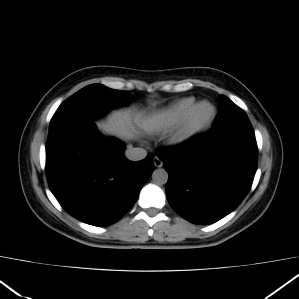File:Ampullary tumor (Radiopaedia 22787-22816 Axial non-contrast 3).jpg