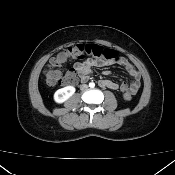 File:Ampullary tumor (Radiopaedia 22787-22816 B 51).jpg