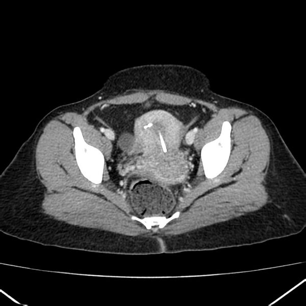 File:Ampullary tumor (Radiopaedia 22787-22816 C 61).jpg